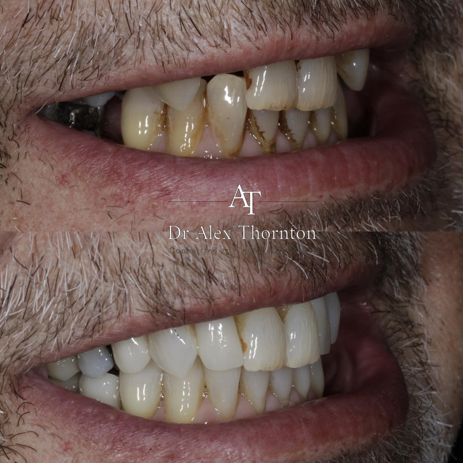 Full mouth rehabilitation — left lateral