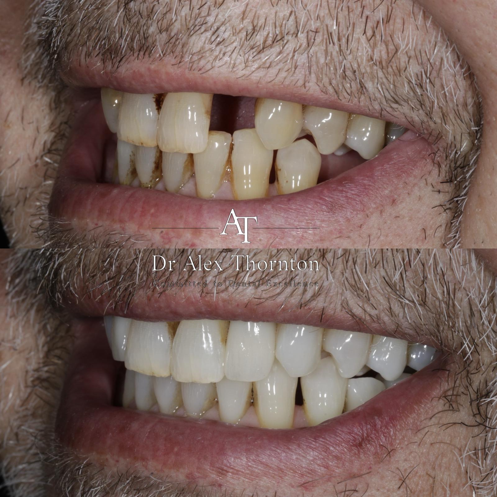 Full mouth rehabilitation — right lateral