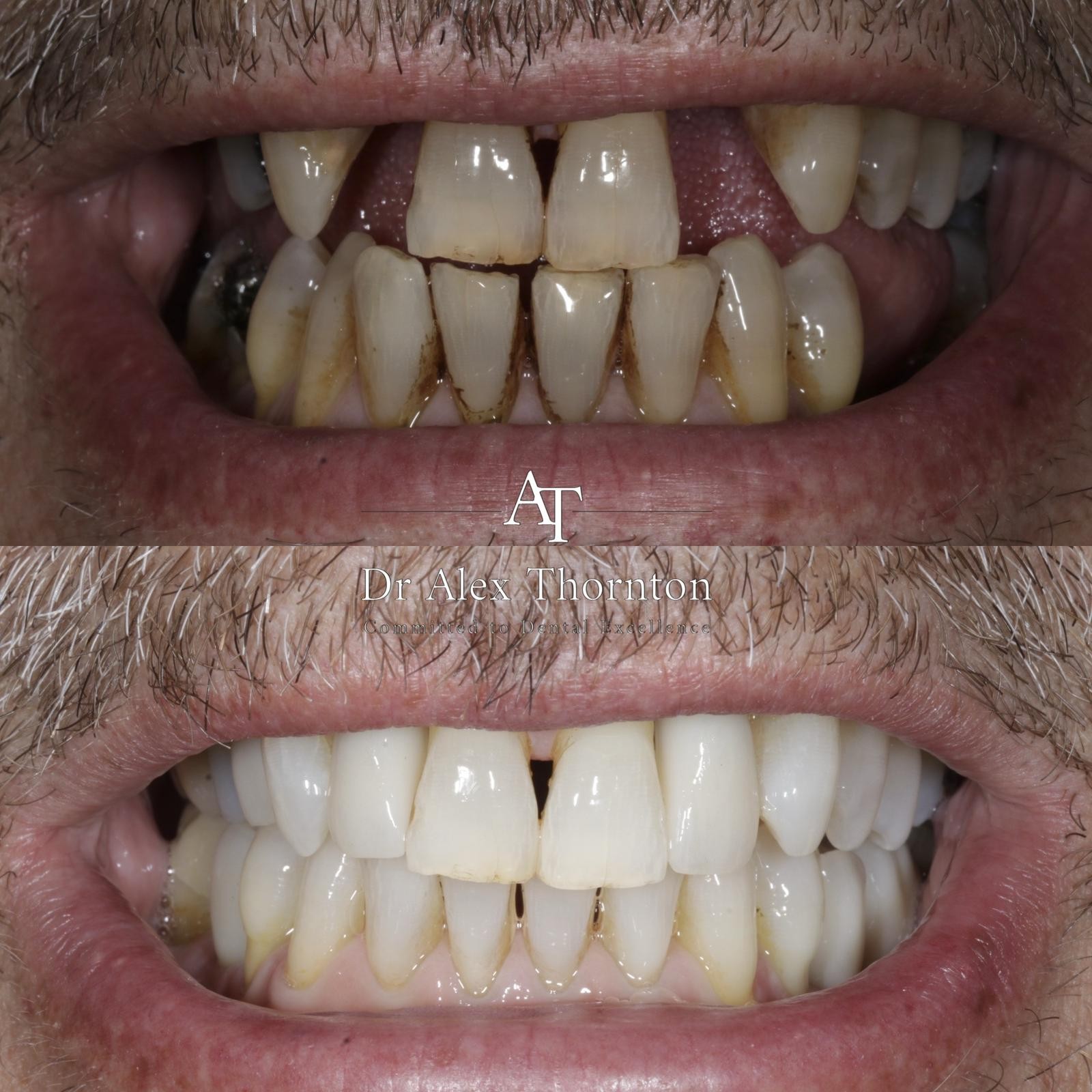 Full mouth rehabilitation — frontal